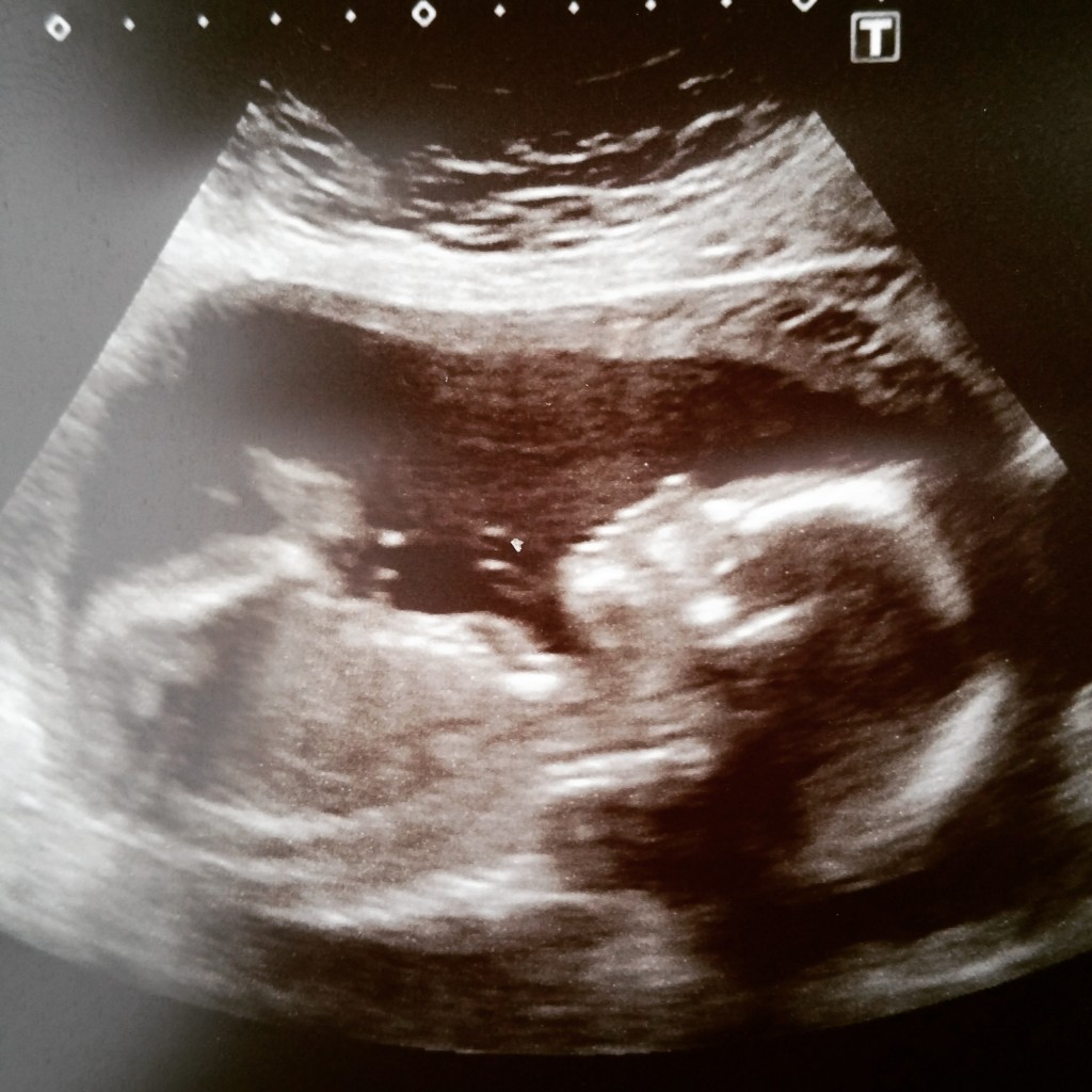 My Pregnancy – The 20 Week Scan